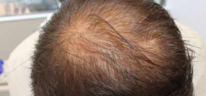 Hair Transplant Before & After Patient #14186