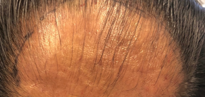 Hair Transplant Before & After Patient #14190