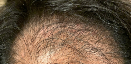 Hair Transplant Before & After Patient #14190