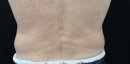 Body Contouring Before & After Patient #14251