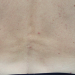 Body Contouring Before & After Patient #14251