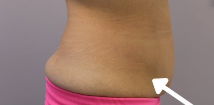Body Contouring Before & After Patient #14242