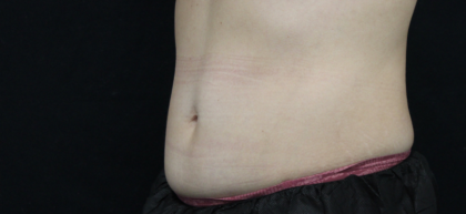 Body Contouring Before & After Patient #14242
