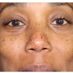 Derm & Skincare Before & After Patient #14422