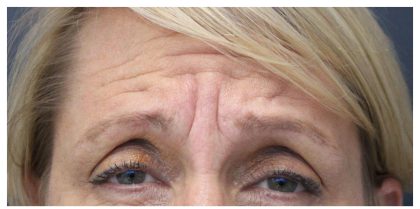 Injectables & Fillers Before & After Patient #14552