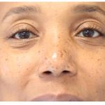 Derm & Skincare Before & After Patient #14422