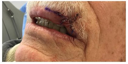 Mohs Surgery Before & After Patient #14409