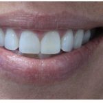 Gummy Smiles Before & After Patient #14400
