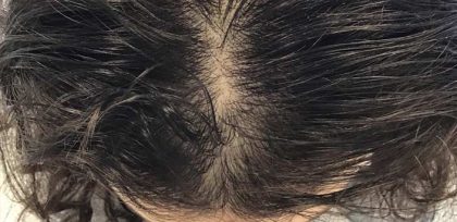 Hair Loss Treatment Before & After Patient #14385