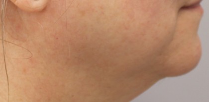 Skin Tightening Before & After Patient #14821