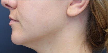 Jawline Contouring Before & After Patient #14951