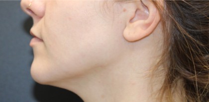 Jawline Contouring Before & After Patient #14951