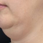 CoolSculpting Before & After Patient #14939