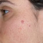 Acne Treatment Before & After Patient #14962