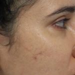 Acne Treatment Before & After Patient #14962