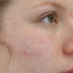 Acne Treatment Before & After Patient #14969