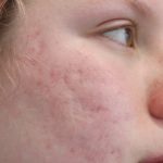 Acne Treatment Before & After Patient #14969