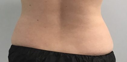 Body Contouring Before & After Patient #14836