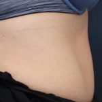 Body Contouring Before & After Patient #14836