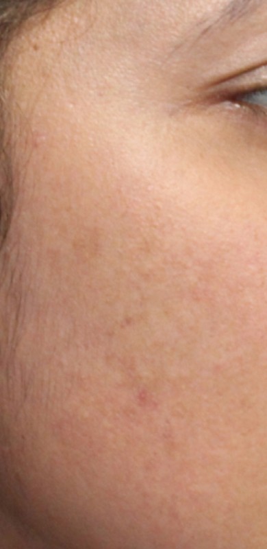 Chemical Peel Before & After Patient #14867