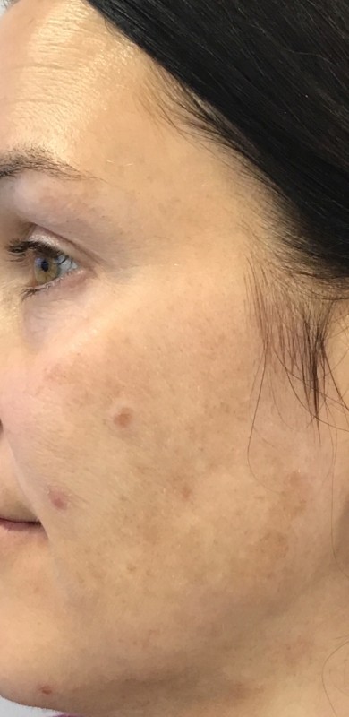 Chemical Peel Before & After Patient #14875