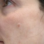 Chemical Peel Before & After Patient #14875