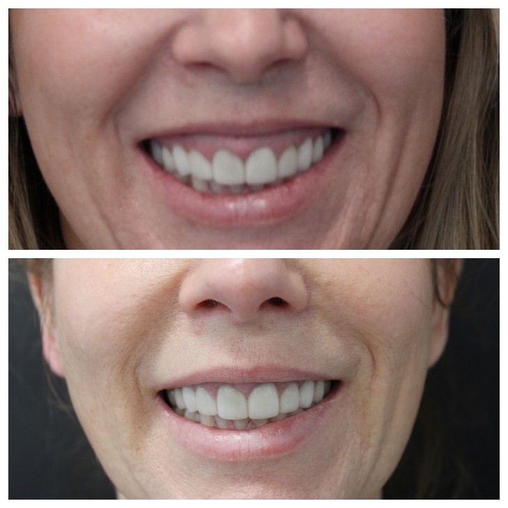 When do you need Dental fillers? – Community Smiles