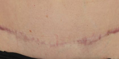 Scar Removal Before & After Patient #14878
