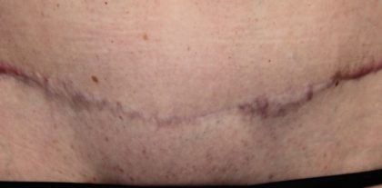 Scar Removal Before & After Patient #14878