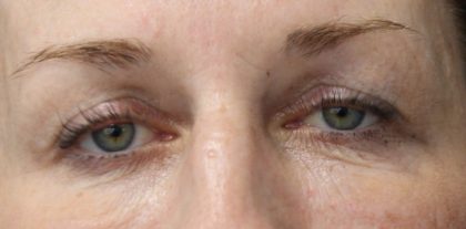 Ultherapy Before & After Patient #14985
