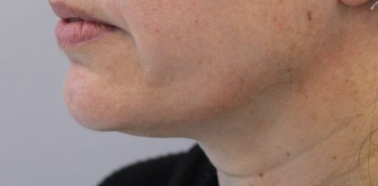 Ultherapy Before & After Patient #14985