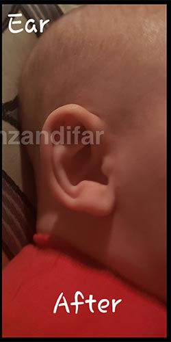 Ear Well Before & After Patient #15235