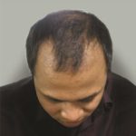 Scalp Hair Transplant Before & After Patient #15387