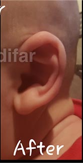 Ear Well Before & After Patient #15235
