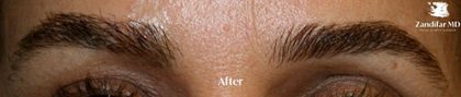 Eyebrow Hair Transplant Before & After Patient #15356