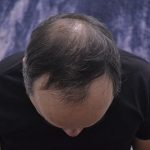 Scalp Hair Transplant Before & After Patient #15380