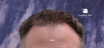 Scalp Hair Transplant Before & After Patient #15381