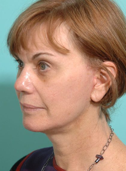 Facelift Before & After Patient #15281