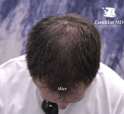 Scalp Hair Transplant Before & After Patient #15381