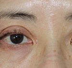 Asian Blepharoplasty Before & After Patient #15255