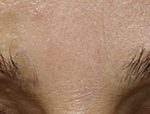 Eyebrow Hair Transplant Before & After Patient #15356