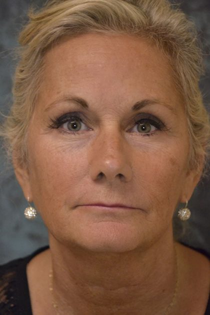 Facelift Before & After Patient #15280