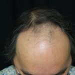 Scalp Hair Transplant Before & After Patient #15380