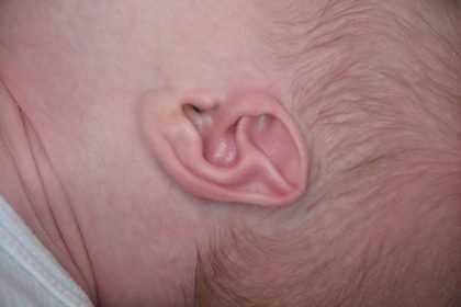 Ear Well Before & After Patient #15233