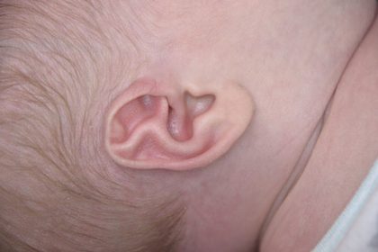 Ear Well Before & After Patient #15234