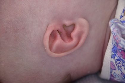 Ear Well Before & After Patient #15234
