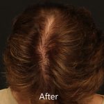 Scalp Hair Transplant Before & After Patient #15364
