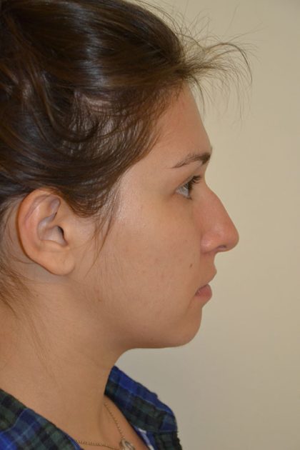 Rhinoplasty Before & After Patient #15469