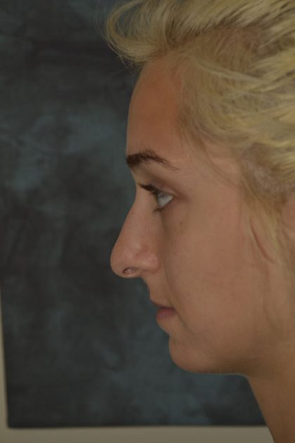Rhinoplasty Before & After Patient #15470