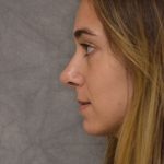 Rhinoplasty Before & After Patient #15470